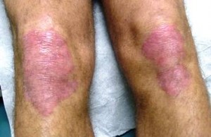 psoriasis on the knees