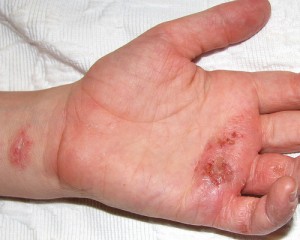 eczema on palm of hand
