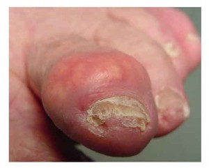 swollen big toe afflicted with gout