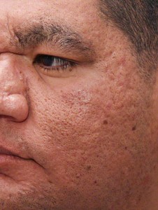 how to get rid of acne scars