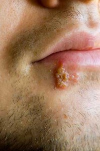 how to get rid of cold sores how to get rid of cold sores