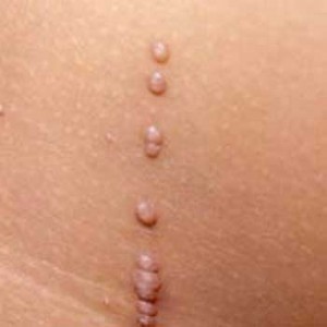 A line of warts down skin A line of warts down skin