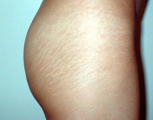 perfect area for stretch mark cream