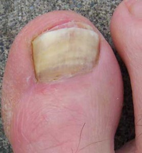 toenail fungus toenail fungus in big toe