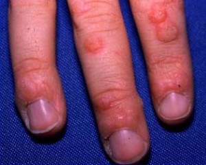warts on hands warts on hands