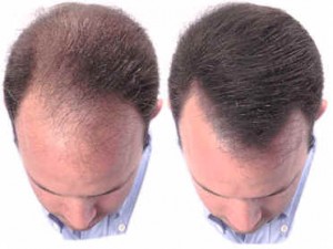 hair re-growth before after photo
