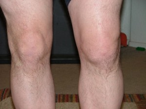 pic of swollen knees with gout