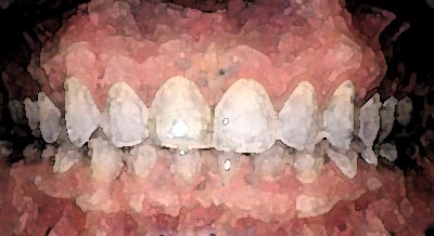 Home Remedies for Gum Disease – Natural Treatments and Prevention Tips