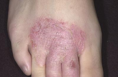 Home Remedies for Eczema – Causes, Symptoms and Treatment Options
