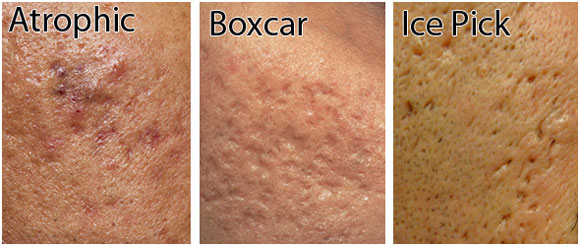3 acne scar types Three acne scar types - atrophic, boxcar and Ice pick