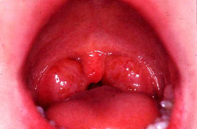 swollen-uvula swollen-uvula-sore-throat