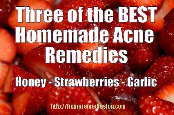 acne remedies meme 3 best homemade acne remedies - meme