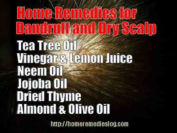 dry scalp remedies meme home remedies for dandruff and dry scalp - meme