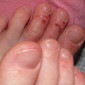 Don’t Scratch – Preventing Eczema Flare-Ups
