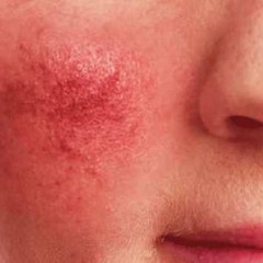 Fighting Rosacea the Ayurvedic Way