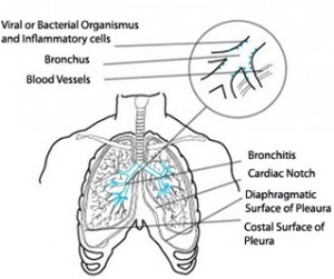 Acute Bronchitis diagram