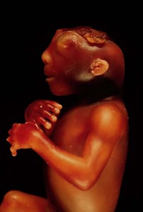 Folate Deficiency Infant Anencephaly Folate Deficiency Infant Anencephaly