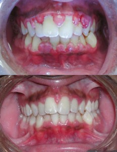 Gingivitis_before_and_after