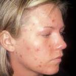 The truth about acne The truth about acne
