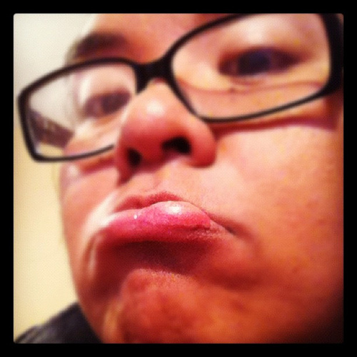 huge lip cold sore face showing swaollen lips with huge cold sore
