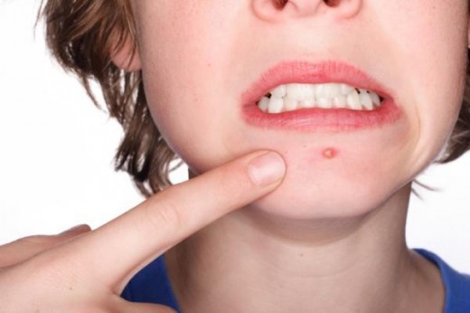 chin pimple girls fave with finger pointing to a pimple on her chin