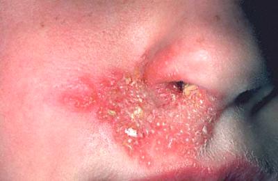 severe cold sore infection severe case of cold sores infection around lower nose area