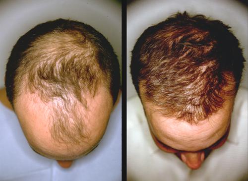 hair growth results before and after hair growth stimulation results on man before and after