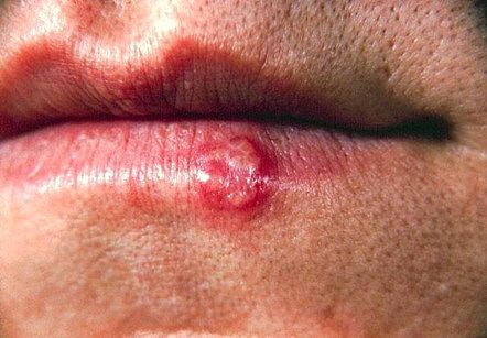 Home Remedies for Cold Sores – Controlling the Herpes Virus Lip Blister