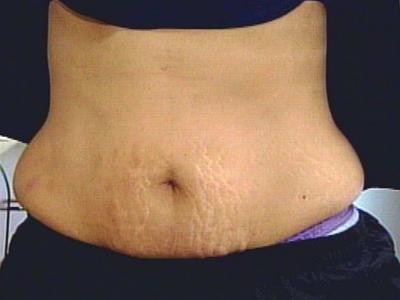 Home Remedies for Stretch Marks – Natural Removal Tips