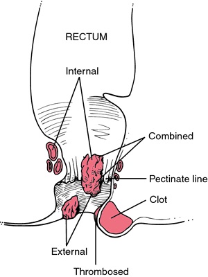 thrombosed hemorrhoid diagram thrombosed hemorrhoid diagram