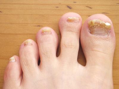 How to Get Rid of Yellow Toenails – Nail Fungus Treatment