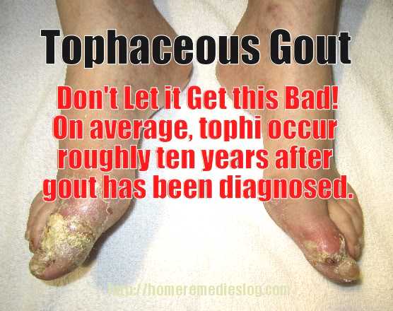 tophaceous gout - meme tophaceous gout - meme