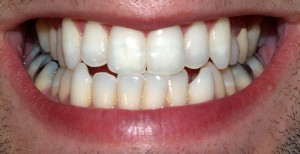 white teeth